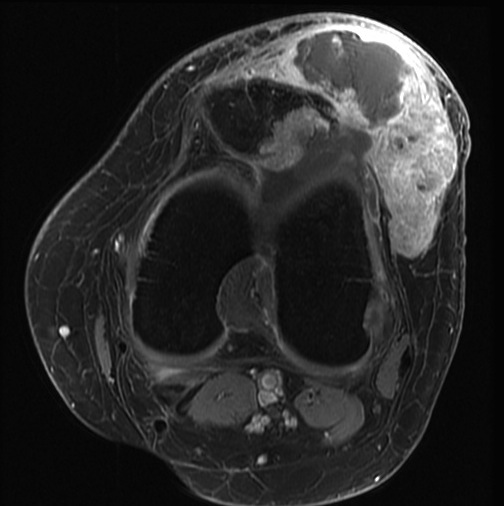 Figure 5 for case synovial sarcoma ( RID4558 )